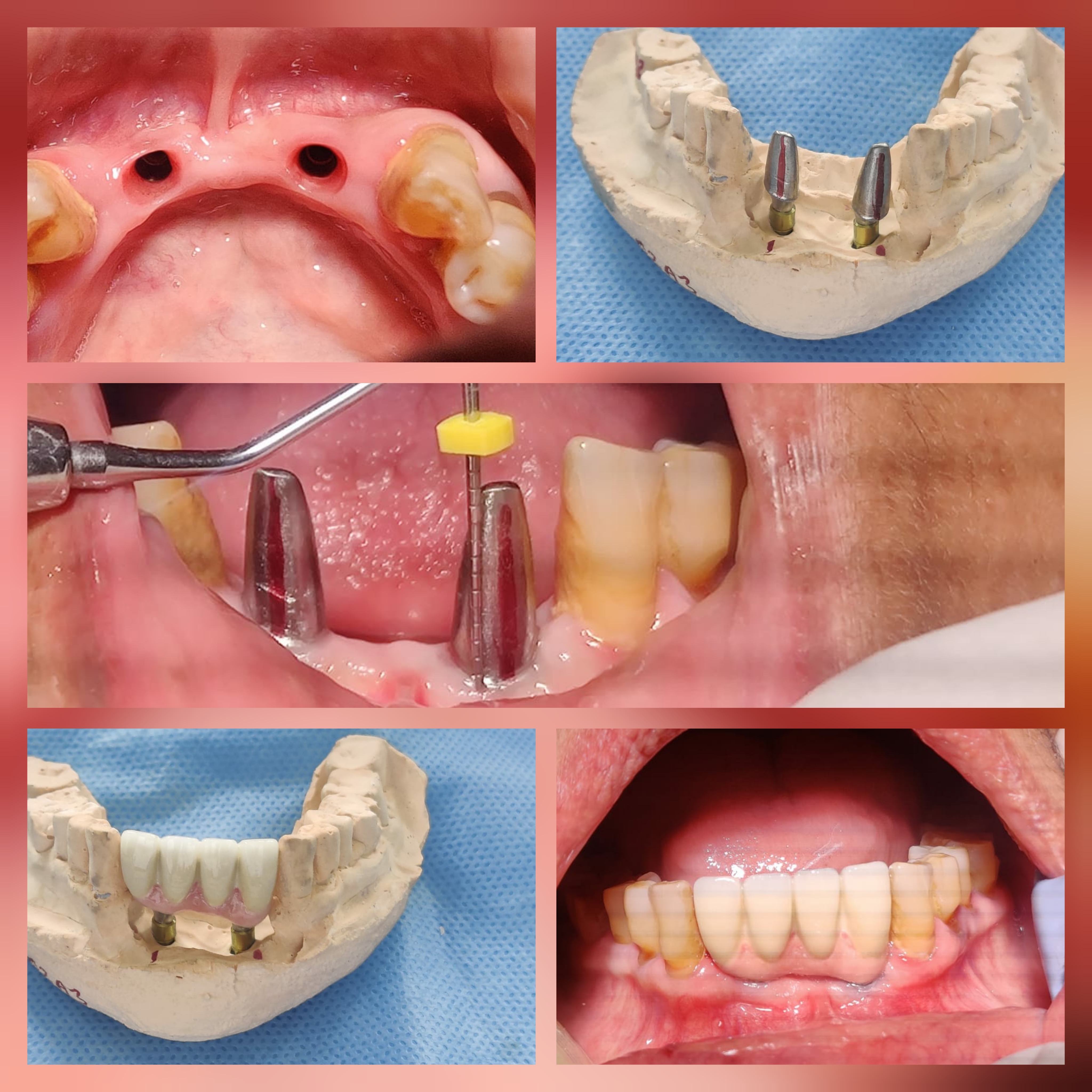 Dental Implants