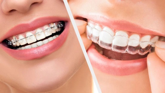 Orthodontic Treatment