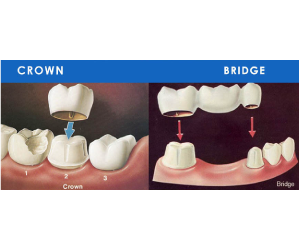 Dental Crown and Bridges